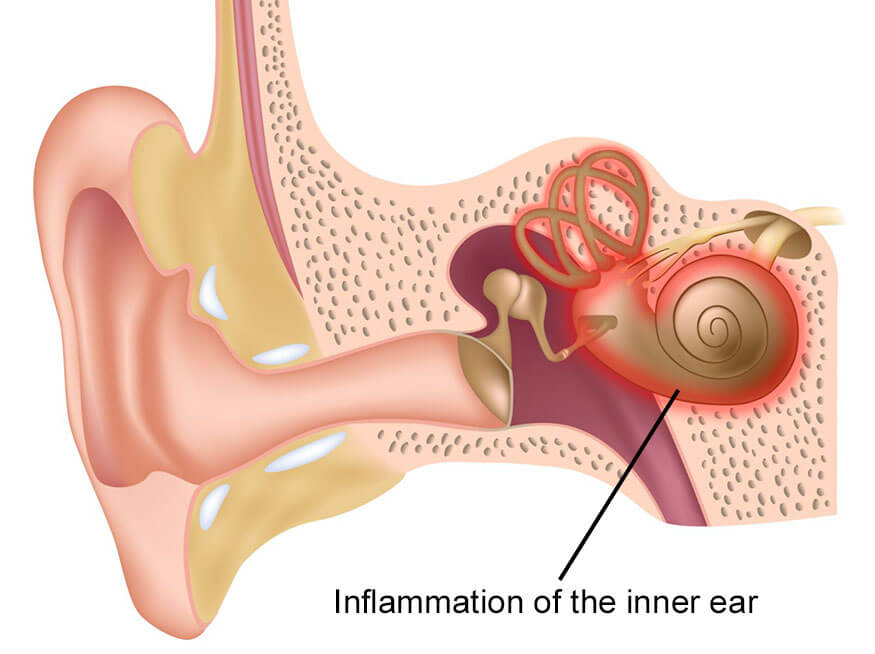 labyrinthitis-illustration